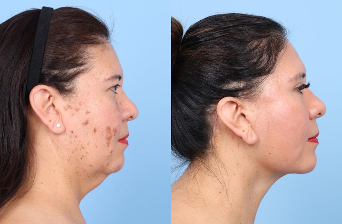 Facelift Before & After Gallery - Patient 396972 - Image 4