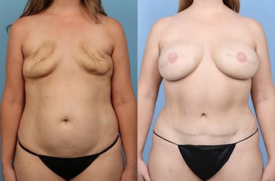 DIEP Flap Reconstruction Before & After Gallery - Patient 598296 - Image 1