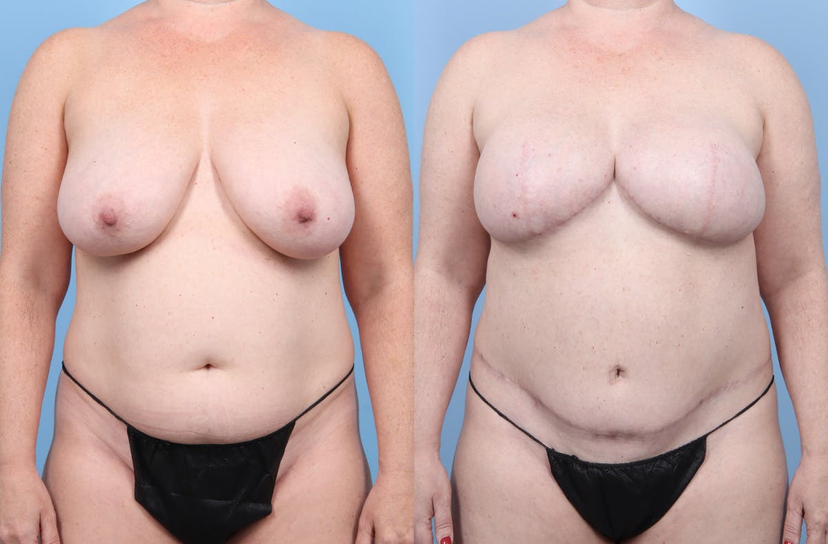 DIEP Flap Reconstruction Before & After Gallery - Patient 405285 - Image 1