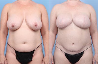 DIEP Flap Reconstruction Before & After Gallery - Patient 405285 - Image 1