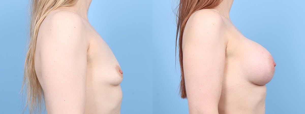 Breast Augmentation Before & After Gallery - Patient 107324 - Image 3