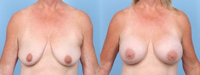 Breast Augmentation Before & After Gallery - Patient 294481 - Image 1