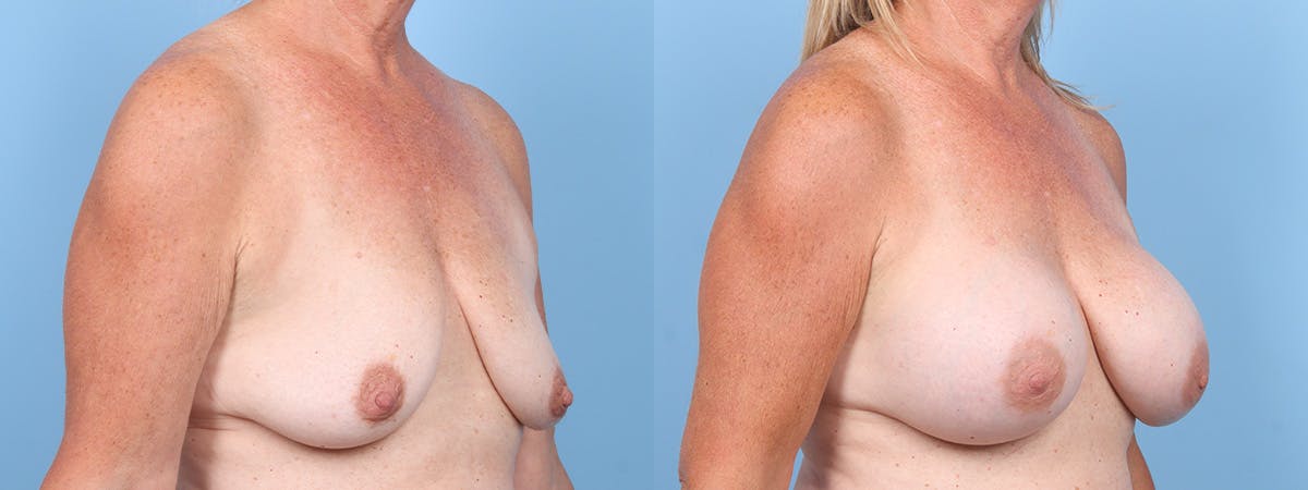 Breast Augmentation Before & After Gallery - Patient 294481 - Image 2