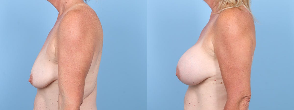 Breast Augmentation Before & After Gallery - Patient 294481 - Image 5