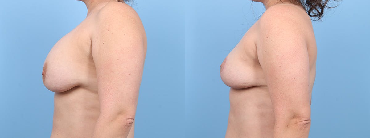 Breast Lift w/ Fat Grafting Before & After Gallery - Patient 252195 - Image 5
