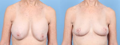 Implant Removal w/ Lift Before & After Gallery - Patient 205410 - Image 1