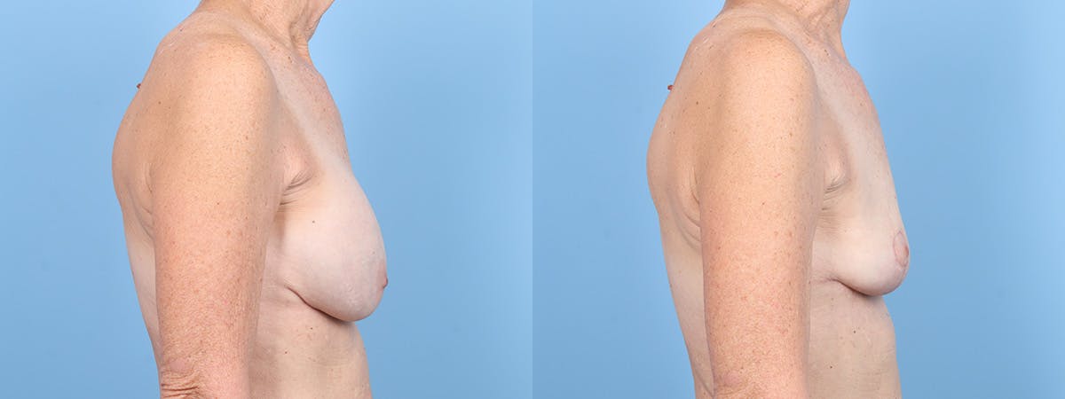 Implant Removal w/ Lift Before & After Gallery - Patient 205410 - Image 3