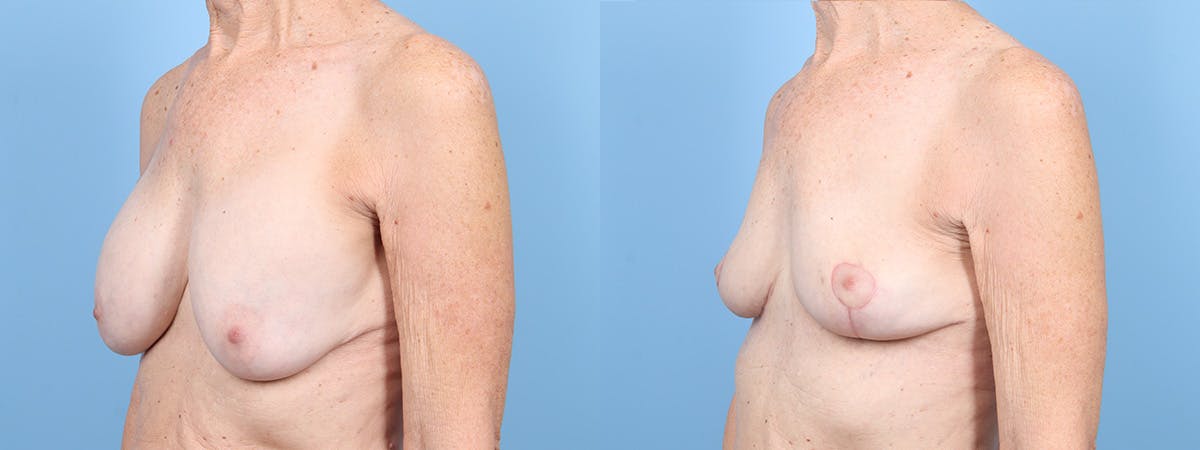 Implant Removal w/ Lift Before & After Gallery - Patient 205410 - Image 4