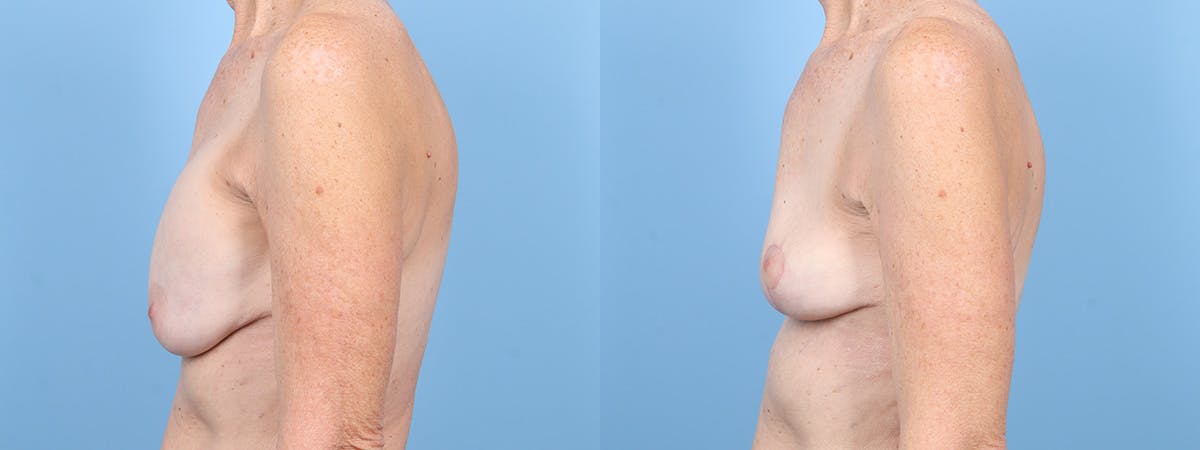 Implant Removal w/ Lift Before & After Gallery - Patient 205410 - Image 5