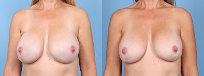 Direct to Implant Reconstruction Before & After Gallery - Patient 181796 - Image 1