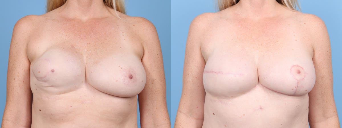 DIEP Flap Reconstruction Before & After Gallery - Patient 282181 - Image 1