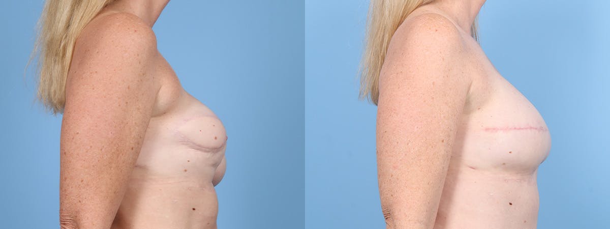 DIEP Flap Reconstruction Before & After Gallery - Patient 282181 - Image 3