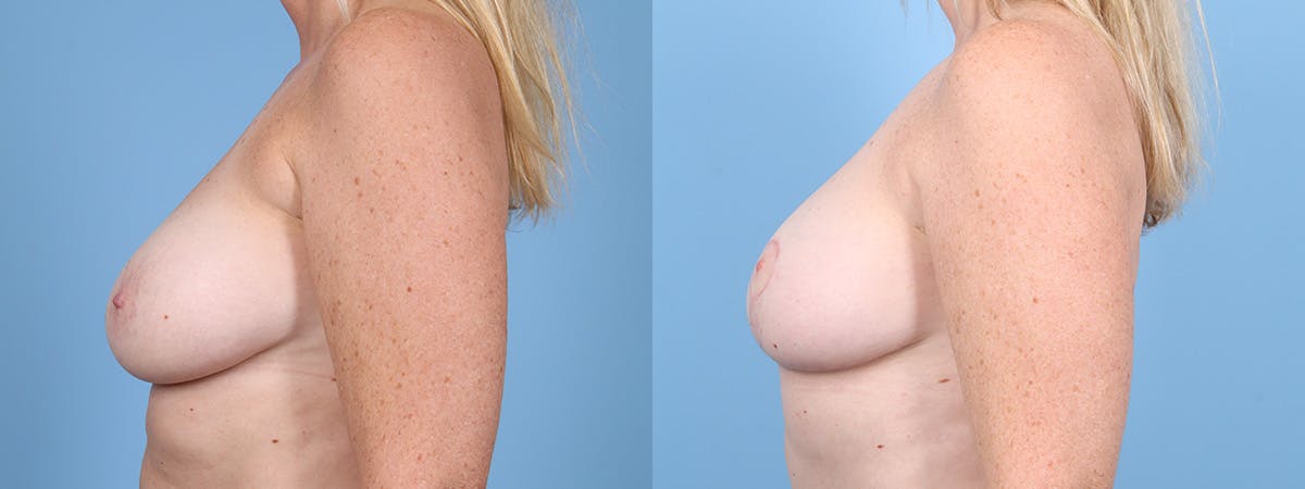 DIEP Flap Reconstruction Before & After Gallery - Patient 282181 - Image 5