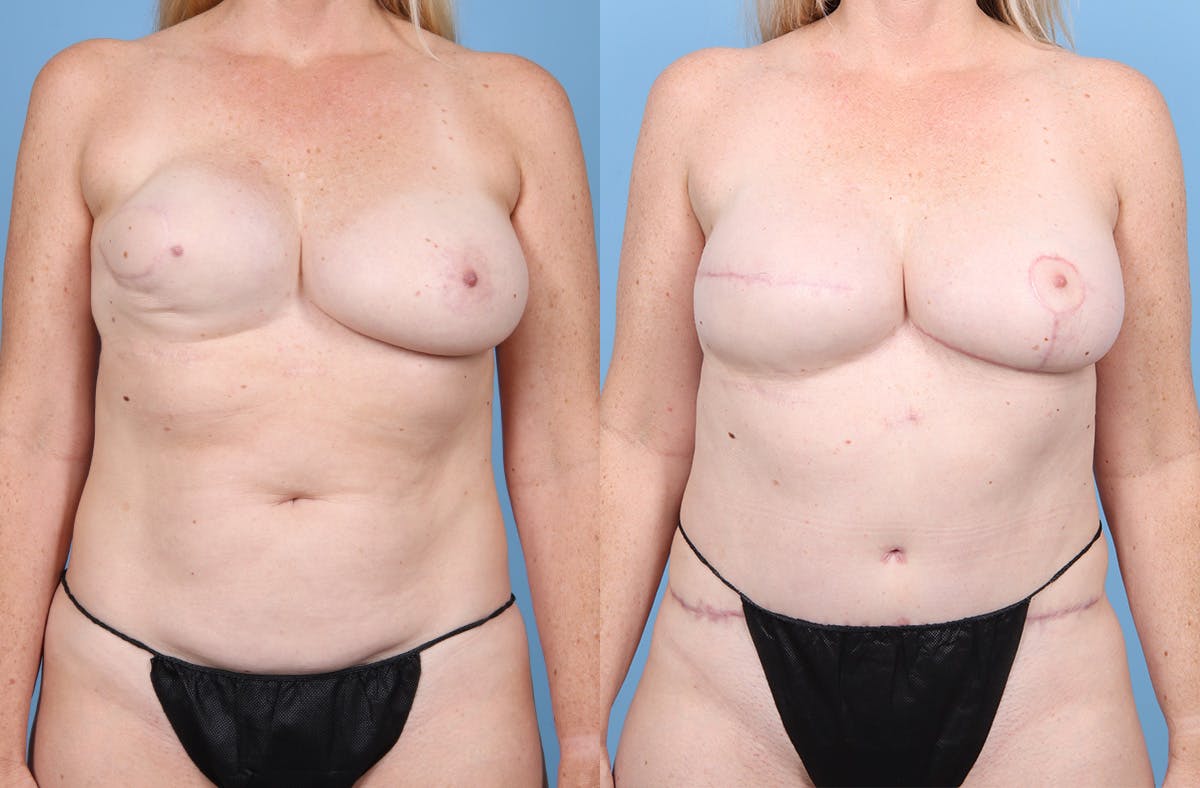 DIEP Flap Reconstruction Before & After Gallery - Patient 282181 - Image 1