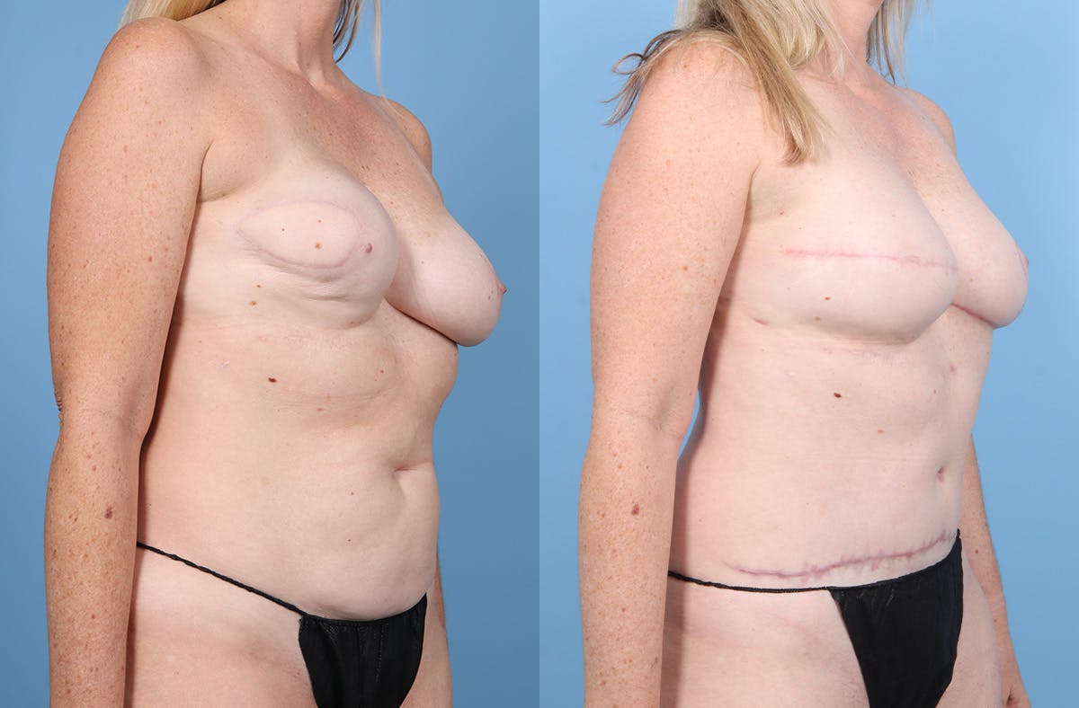 DIEP Flap Reconstruction Before & After Gallery - Patient 282181 - Image 2