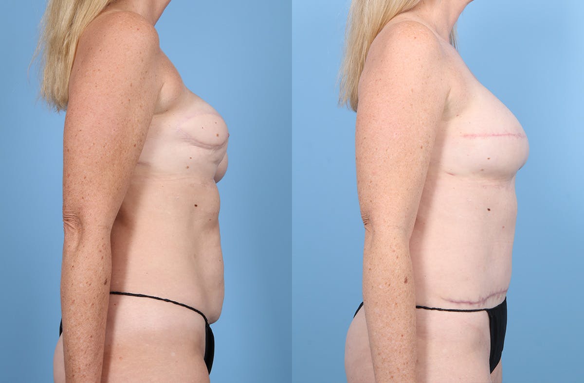 DIEP Flap Reconstruction Before & After Gallery - Patient 282181 - Image 3
