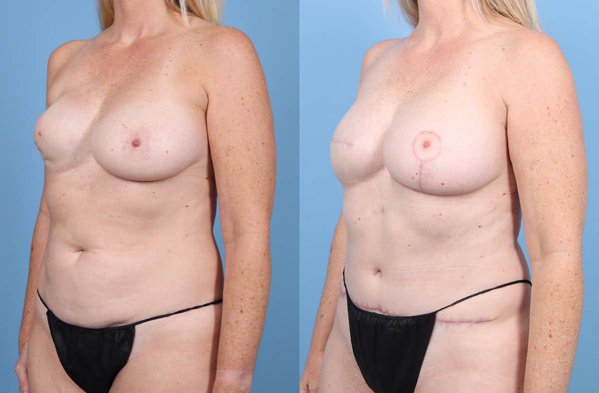 DIEP Flap Reconstruction Before & After Gallery - Patient 282181 - Image 4