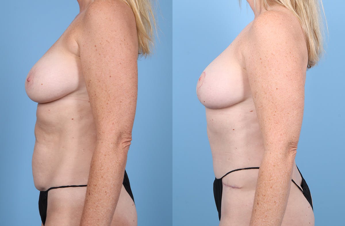 DIEP Flap Reconstruction Before & After Gallery - Patient 282181 - Image 5