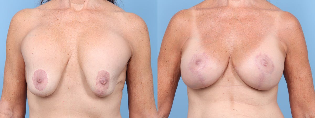 Implant Revision Before & After Gallery - Patient 134469 - Image 1