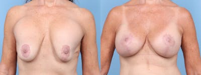 Implant Revision Before & After Gallery - Patient 134469 - Image 1