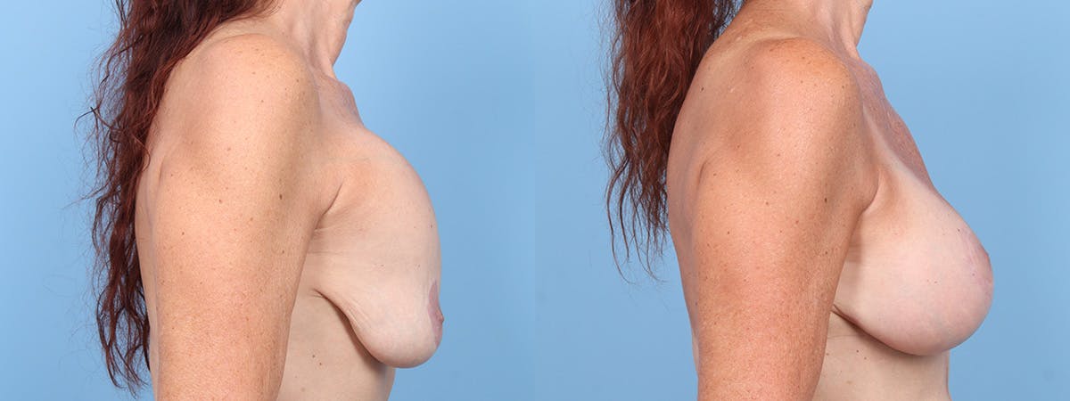 Implant Revision Before & After Gallery - Patient 134469 - Image 3