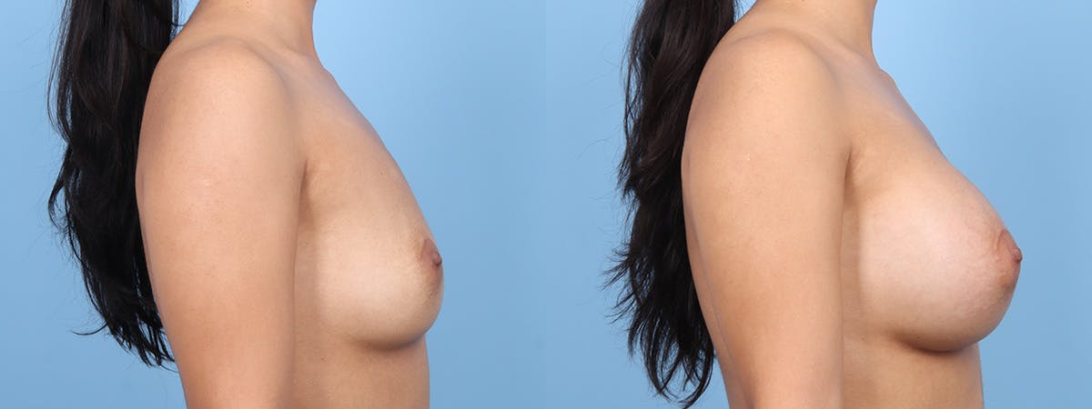 Breast Augmentation Before & After Gallery - Patient 259084 - Image 3