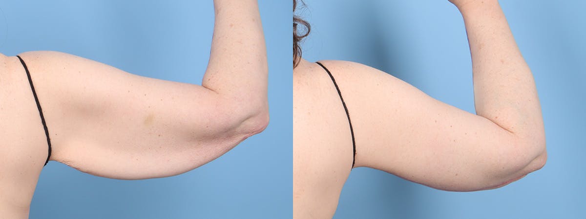 Arm Lift (Brachioplasty) Before & After Gallery - Patient 108696 - Image 2