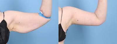 Arm Lift (Brachioplasty) Before & After Gallery - Patient 108696 - Image 1