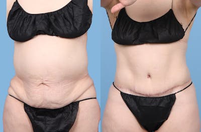 Tummy Tuck Before & After Gallery - Patient 415266 - Image 1