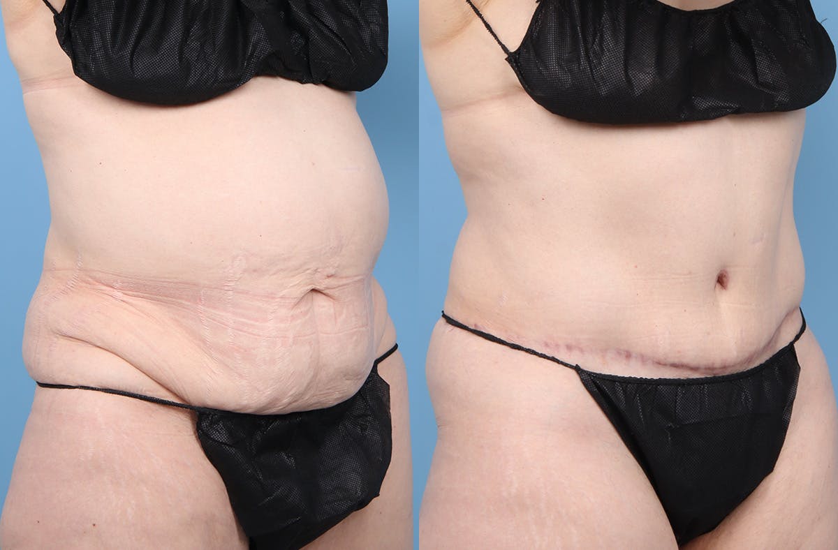 Tummy Tuck Before & After Gallery - Patient 415266 - Image 2