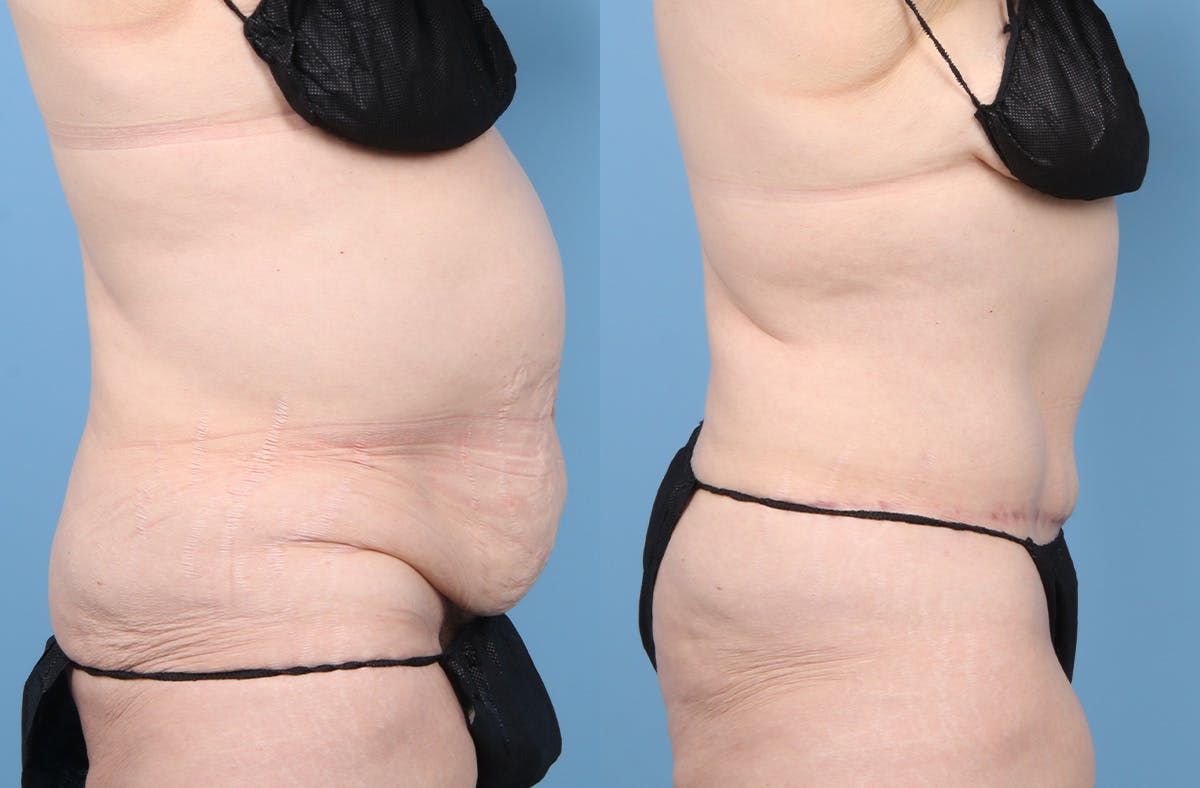 Tummy Tuck Before & After Gallery - Patient 415266 - Image 3