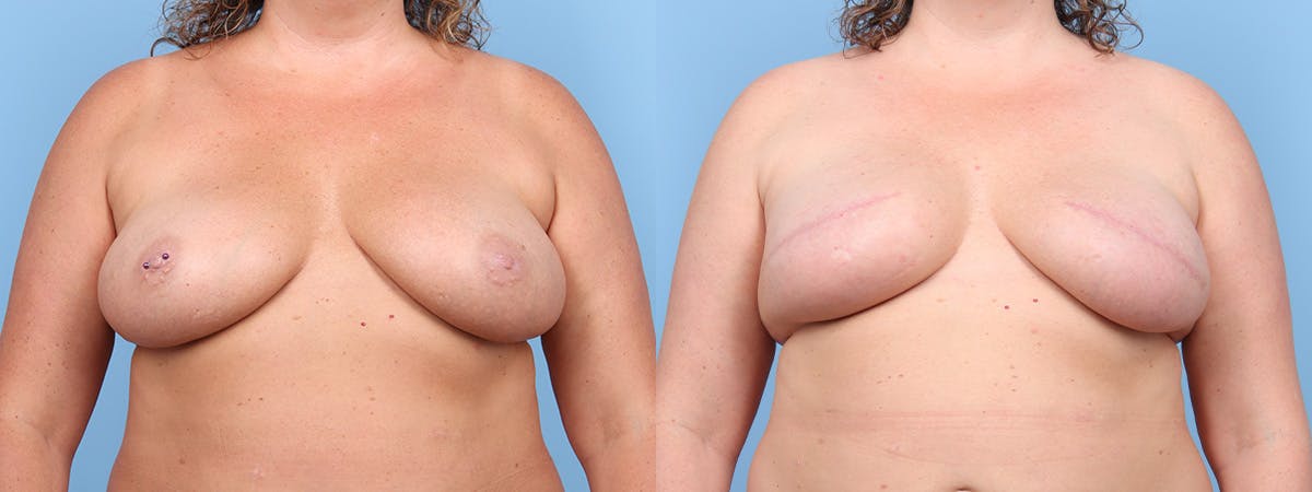 Direct to Implant Reconstruction Before & After Gallery - Patient 272915 - Image 1
