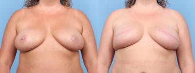 Direct to Implant Reconstruction Before & After Gallery - Patient 272915 - Image 1