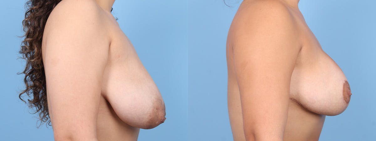 Breast Augmentation w/ Lift Before & After Gallery - Patient 936067 - Image 3