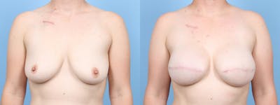 Direct to Implant Reconstruction Before & After Gallery - Patient 171916 - Image 1