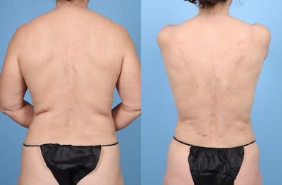 Liposuction Before & After Gallery - Patient 422264 - Image 1