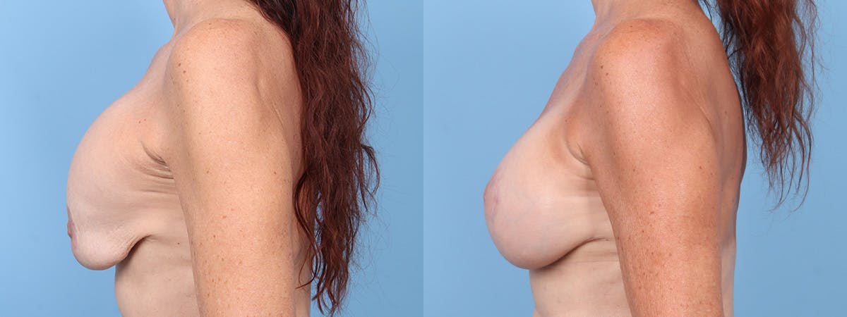 Implant Revision Before & After Gallery - Patient 134469 - Image 5