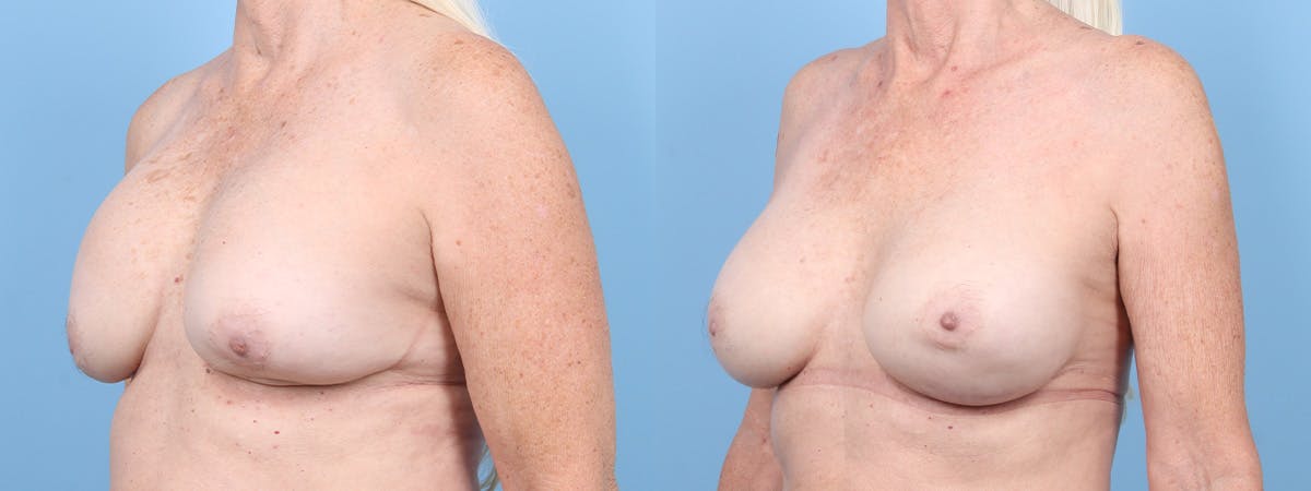 Implant Revision Before & After Gallery - Patient 278826 - Image 4