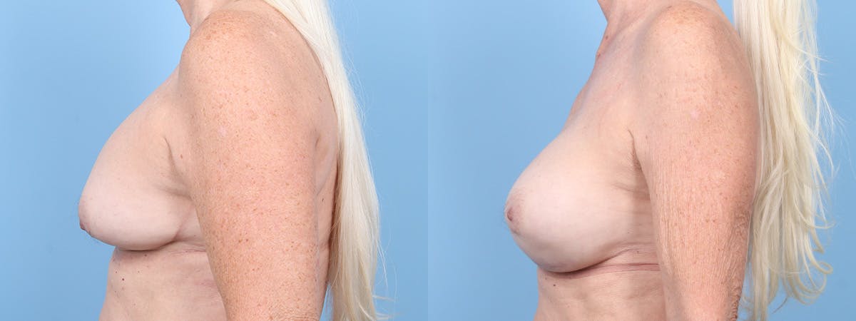 Implant Revision Before & After Gallery - Patient 278826 - Image 5