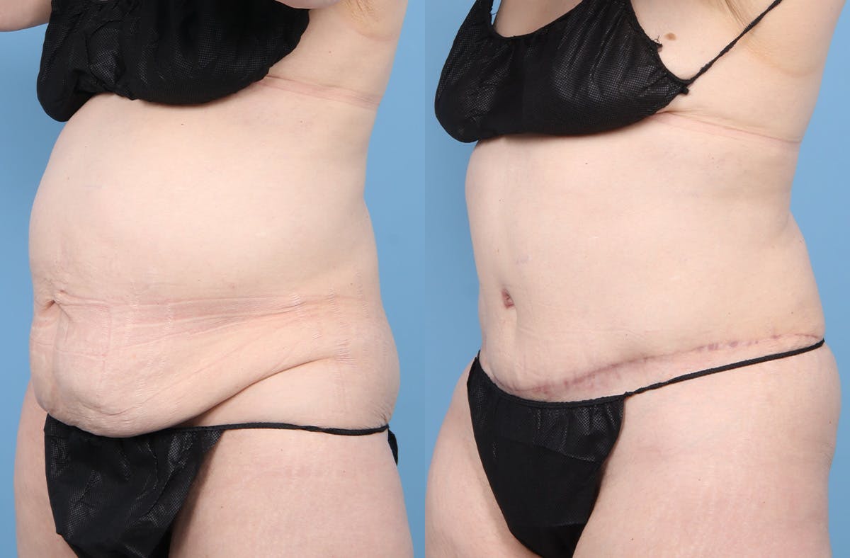 Tummy Tuck Before & After Gallery - Patient 415266 - Image 4