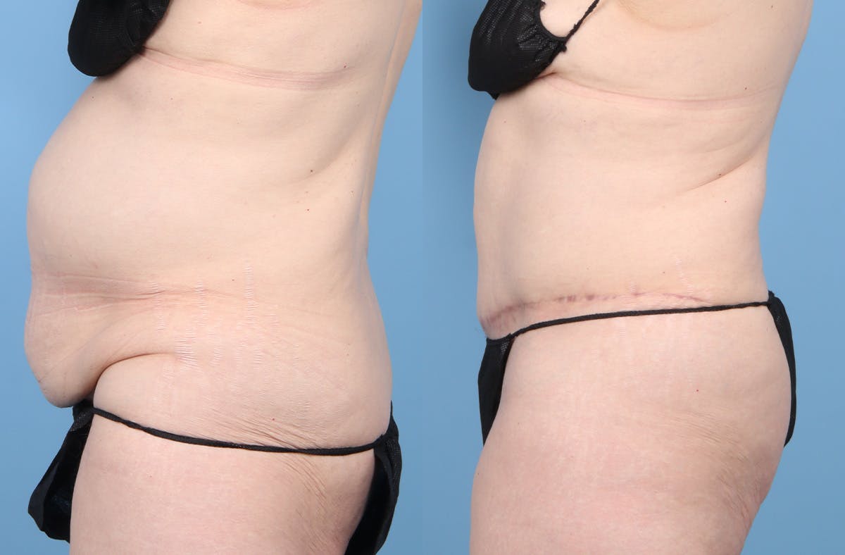 Tummy Tuck Before & After Gallery - Patient 415266 - Image 5