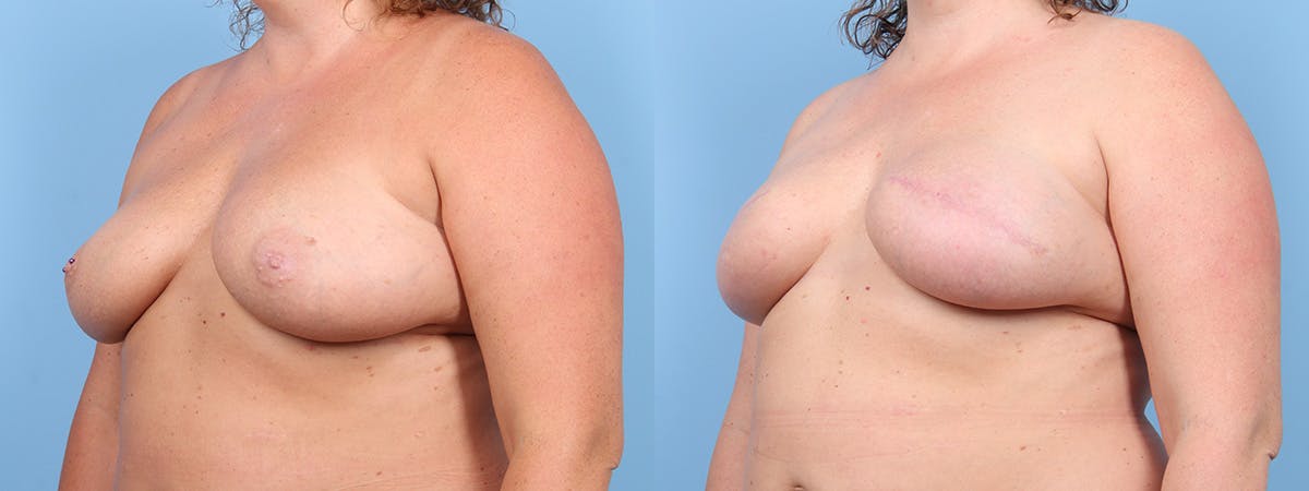 Direct to Implant Reconstruction Before & After Gallery - Patient 272915 - Image 4
