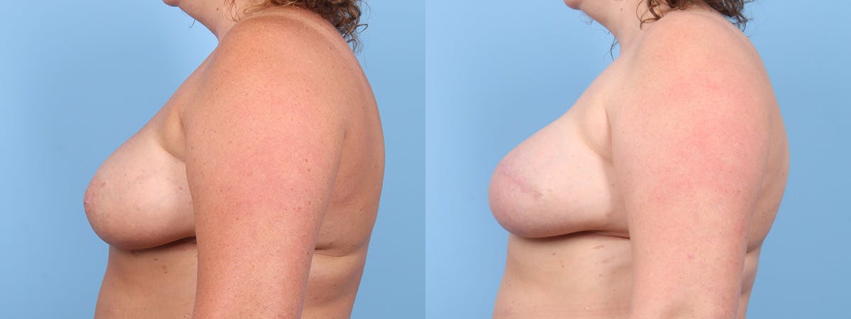 Direct to Implant Reconstruction Before & After Gallery - Patient 272915 - Image 5