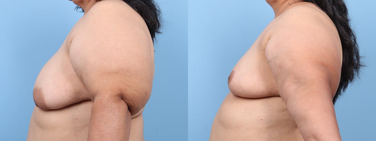 Oncoplastic Reconstruction Before & After Gallery - Patient 219897 - Image 5