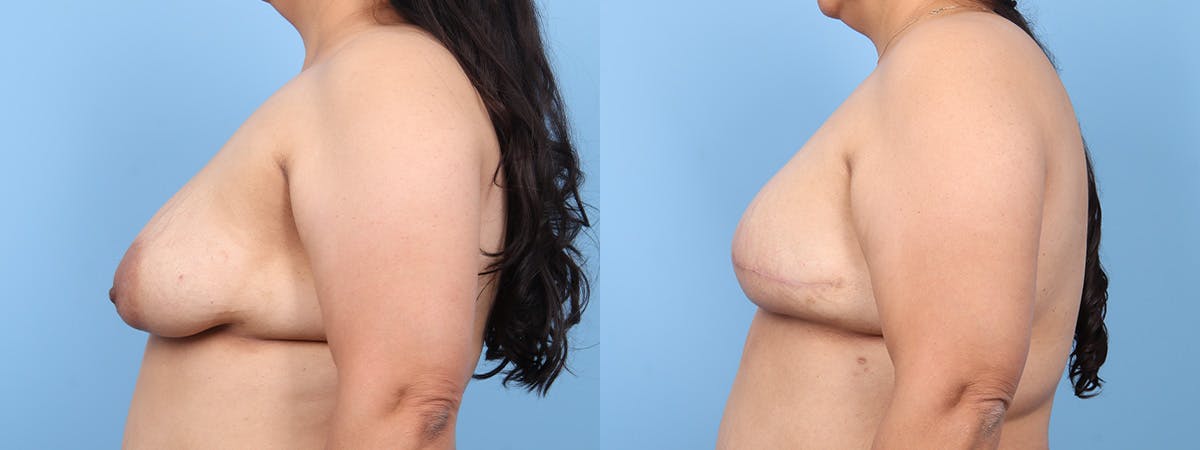 Direct to Implant Reconstruction Before & After Gallery - Patient 388159 - Image 5