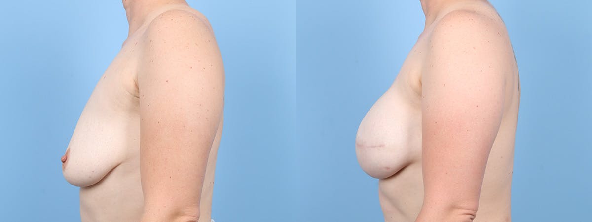 Direct to Implant Reconstruction Before & After Gallery - Patient 171916 - Image 5