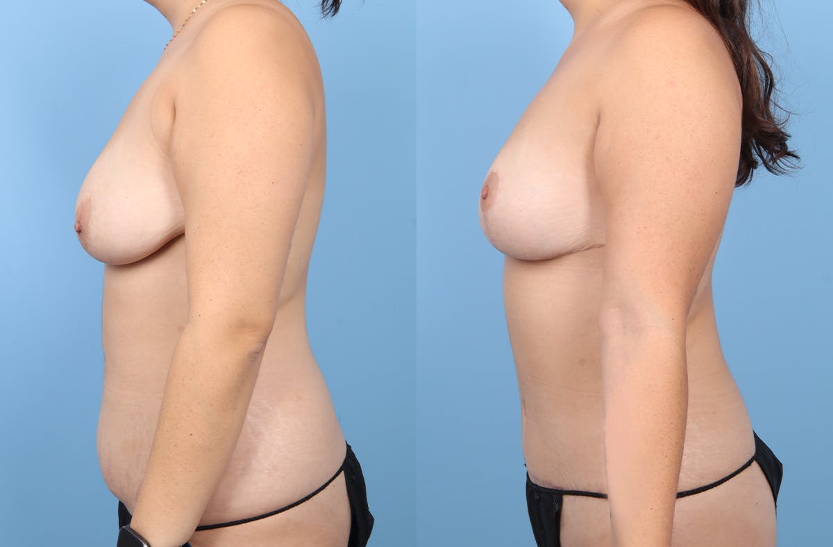 Tummy Tuck Before & After Gallery - Patient 304906 - Image 5