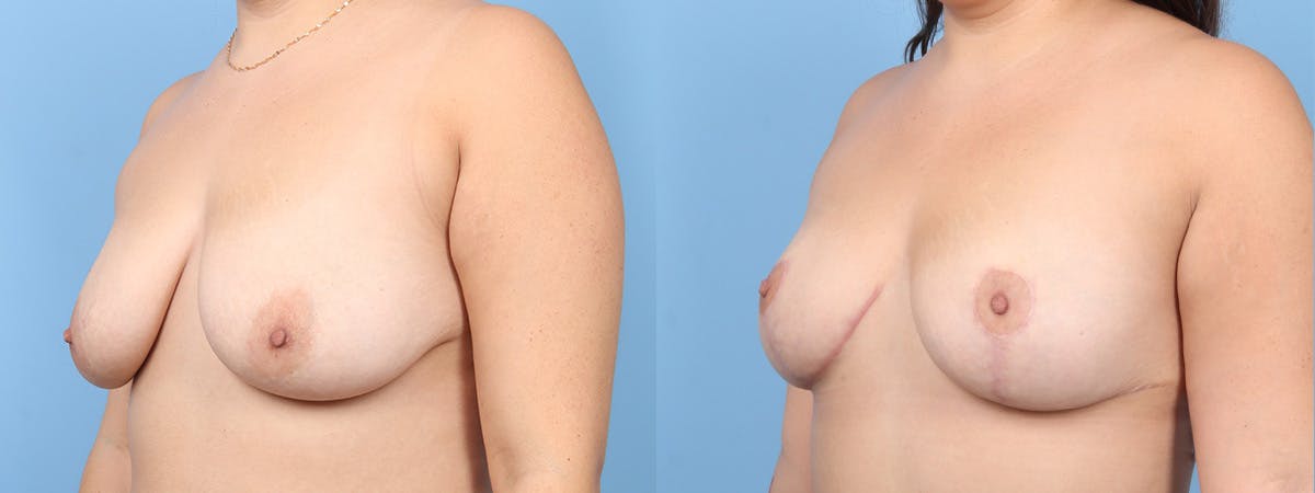 Mastopexy (Breast LIft) Before & After Gallery - Patient 146362 - Image 4