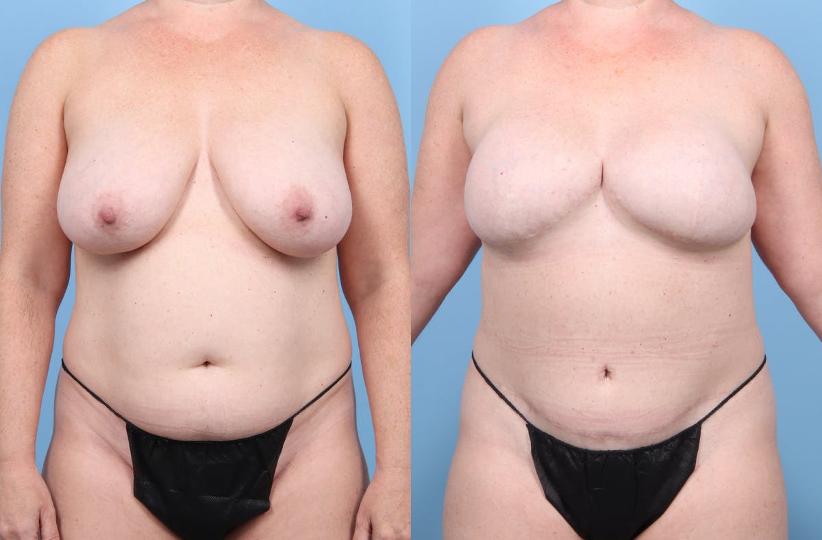 DIEP Flap Reconstruction Before & After Gallery - Patient 405285 - Image 1
