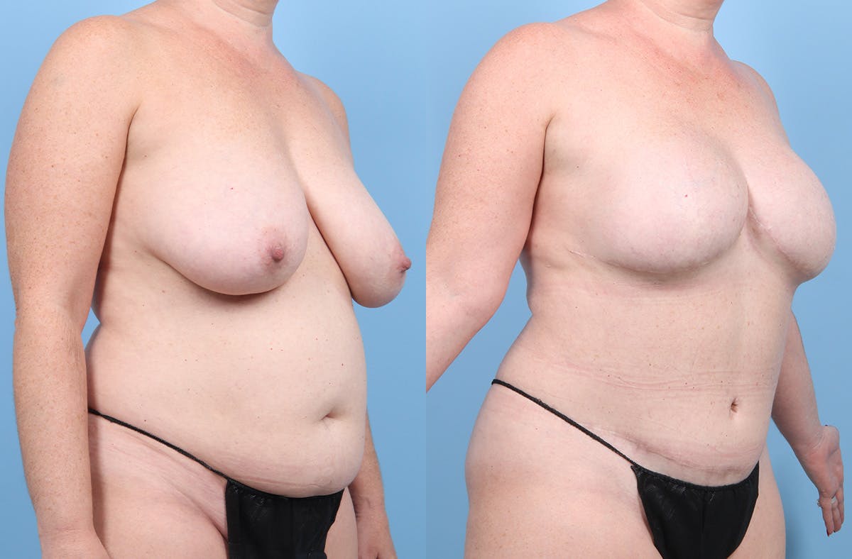 DIEP Flap Reconstruction Before & After Gallery - Patient 405285 - Image 3